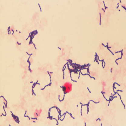 Gram-positive Streptococcus agalactiae (Group B Streptococci) in chains observed in blood culture ~ Dr Timothy Barkham, Department of Laboratory Medicine, Tan Tock Seng Hospital