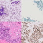 A: Diff-Quik, B: Pap,
C: H&E Cell Block, D: GATA3 immunoperoxidase