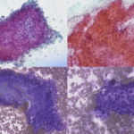 Upper row – Pap stain; Lower row – DQ stain